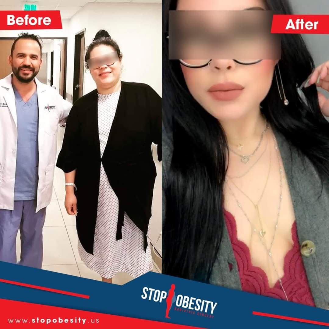 Duodenal switch patient with flat stomach