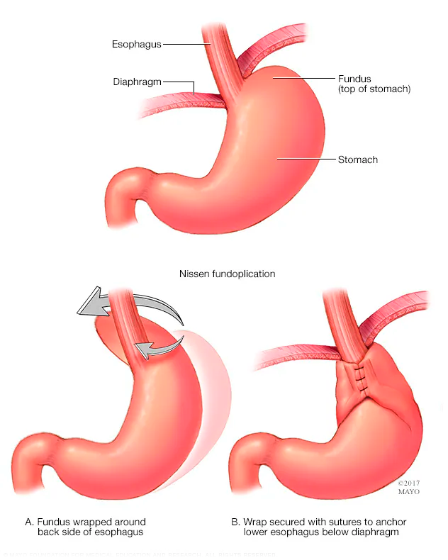 Woman holding hand over stomach after substantial weight loss
